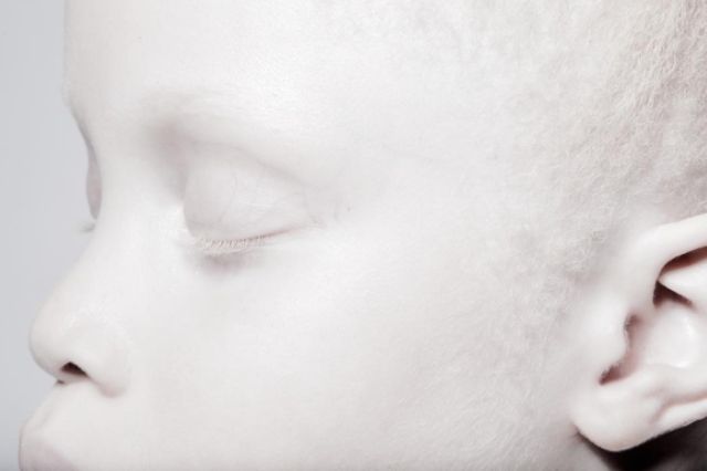 アルビノの子ども